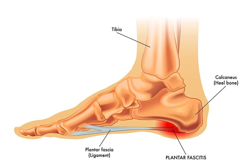 The Consequences of Leaving Plantar Fasciitis Untreated - Plantar Fasciitis