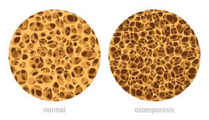Osteoporosis Physicaltherapy